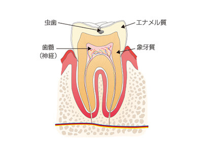 歯の表面の虫歯を表す画像
