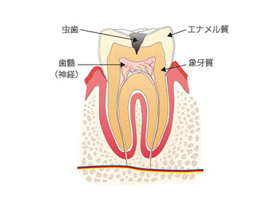 神経に近い虫歯を表す画像