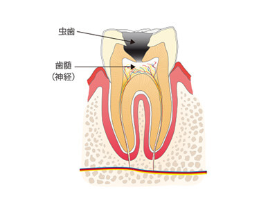 神経にまで及んだ虫歯を表す画像