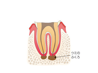 歯の根まで進んだ虫歯を表す画像