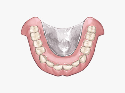 金属床義歯を表す画像