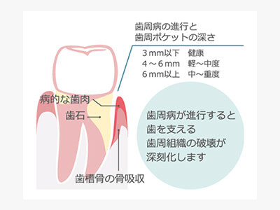 歯周外科治療を表す画像
