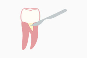 歯槽骨再生治療開始を表す画像