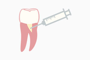 歯槽骨再生治療終了を表す画像