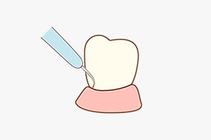 歯垢・歯石の除去を表す画像
