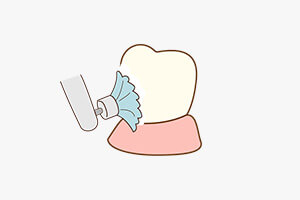 歯面・歯根面の清掃を表す画像